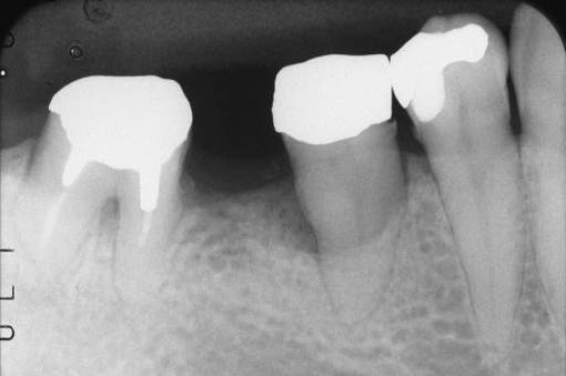 第二小臼歯に重度の歯周病が見つかりました。