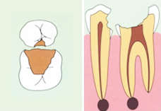 虫歯が重症化（C3～C4）すると→歯内療法が必要となる。