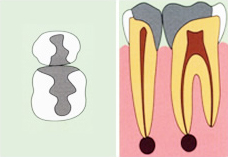 以前治療した歯が再度痛み出した場合→歯内療法が必要となる。