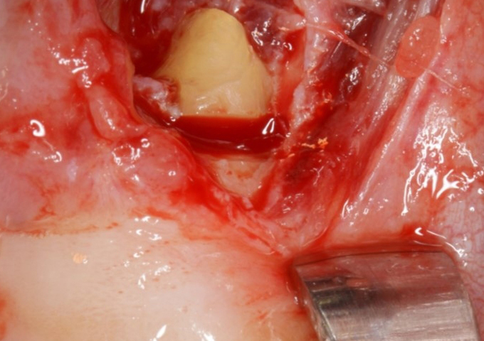 外科的歯内療法(歯根端切除術)で治療した症例⑥