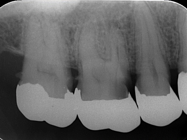 上顎第一大臼歯の口蓋根が2根ある症例①